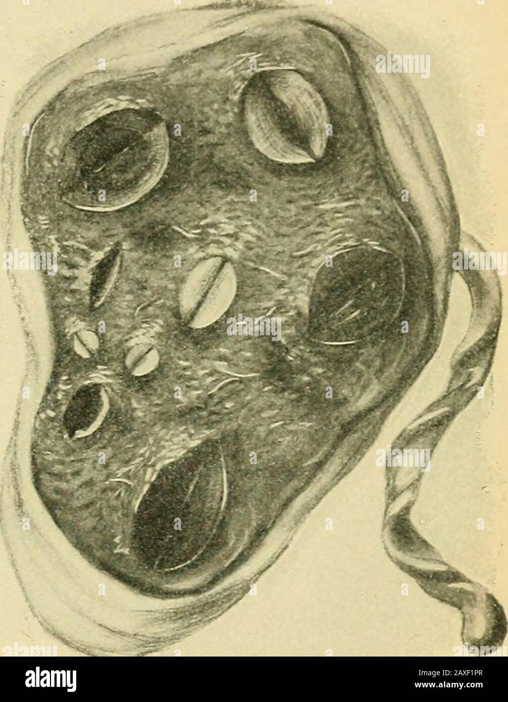 The practice of obstetrics, designed for the use of students and practitioners of medicine . asated blood may be walled ofE by a fibrous envelope, more or less thick,and may consist of reddish or brownish liquid, or even clear serum, while theblood coloring-matter is collected upon the cyst-wall or the neighboring villi.(3) The liquid may contain numerous white blood-corpuscles, giving it theappearance of pus, and such collections have been described as placentalabscesses by various writers. (4) In other cases the fibrin element may bein the ascendency. This condition is found particularly in Stock Photo