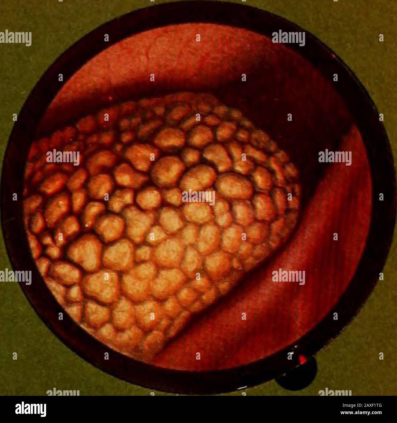 Traitâe pratique de cystoscopie et de cathâetâerisme urâetâeral . Fig. l2 Stock Photo