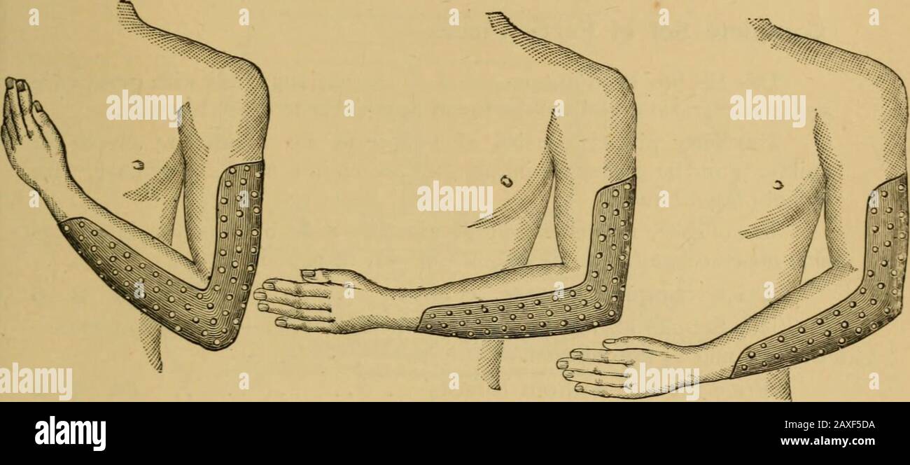 Mettalic Splints Catalogue of surgeons instruments and medical appliancesElectro ...