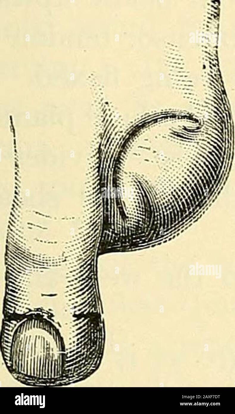 A manual of operative surgery . FIG. 381.—DISARTICU-LATION OF THE.GREAT TOE BYINTERNAL PLAN-TAR FLAP. margin (Fig. 381). chap, vi] AMPUTATION OF THE TOES 565 opened ; the ligament, with the sesamoid bones, remains behind.Divide the lateral ligaments, and finally cut the extensor tendon.Close the fibrous sheath of the flexor tendon (page 492). Hemorrhage.—The outer plantar digital artery will be found cutclose to the web, the inner vessel at the free end of the inner flap.The dorsal digital vessels will probably not need to be secured. The flap is adjusted as shown (Fig. 382). (2) By Racket or Stock Photo