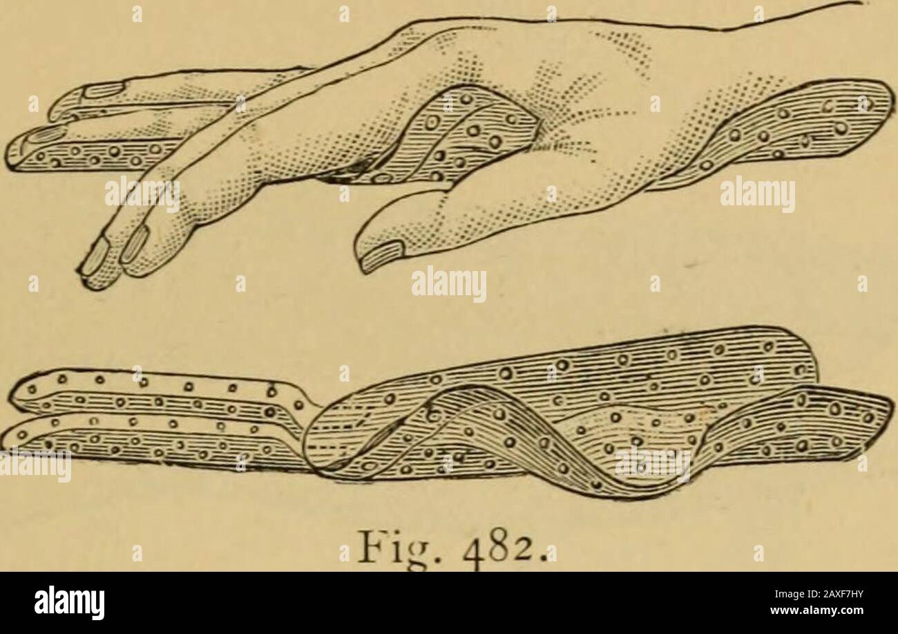 Mettalic Splints Catalogue of surgeons instruments and medical appliancesElectro ...