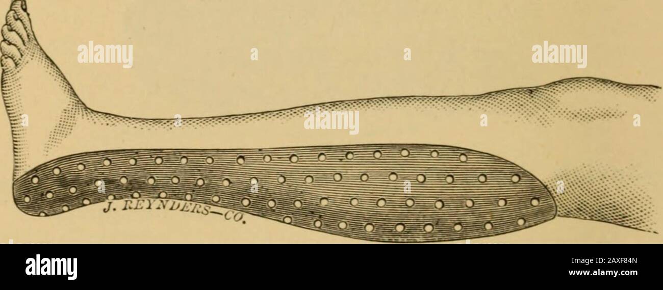 Tibia splint hi-res stock photography and images - Alamy