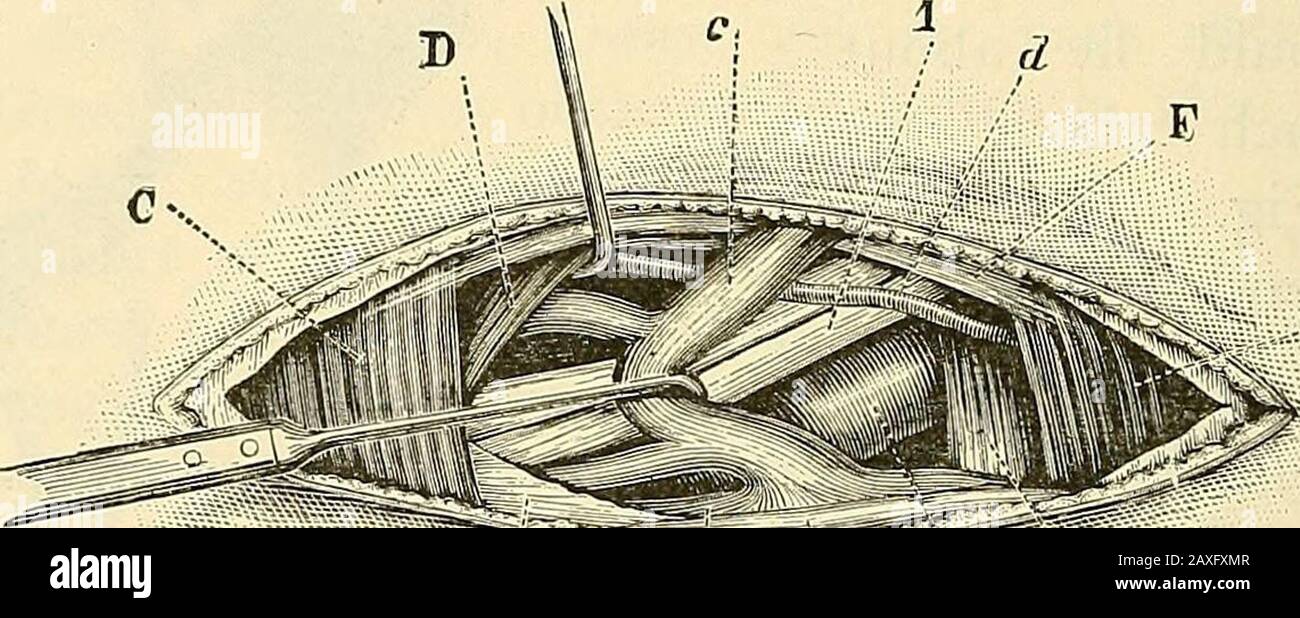 A manual of operative surgery . FIG. 324.—LIGATURE OF THE FIRST PART OF