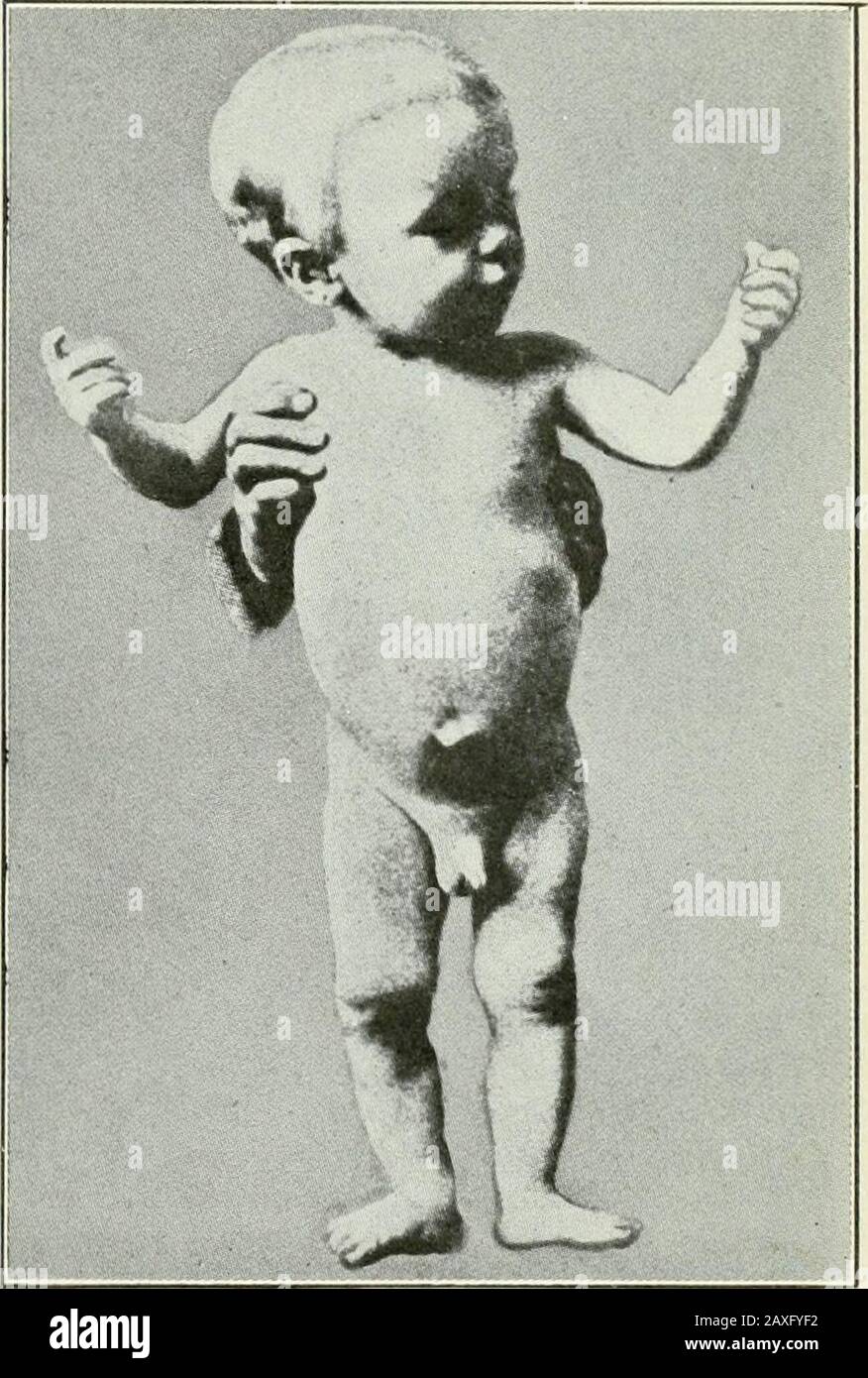 A text-book of pharmacology and therapeutics; or, The action of drugs in health and disease, . A case of sporadic cretinism. Fig. 67, before treatment, age twenty-three months,height 28 inches, circumference of the abdomen 19 inches. Fig. 68, after treatment withthyroid extract for 5^ months, height 30 inches, circumference of abdomen 15 inches. (Osier.) these cases. In goitre the gland is enlarged (hyperplasia), but thisdoes not indicate an excessive formation of secretion, but the reverse;the gland hypertrophies in an effort to compensate for the poverty ofits secretion in thyreoglobulin and Stock Photo