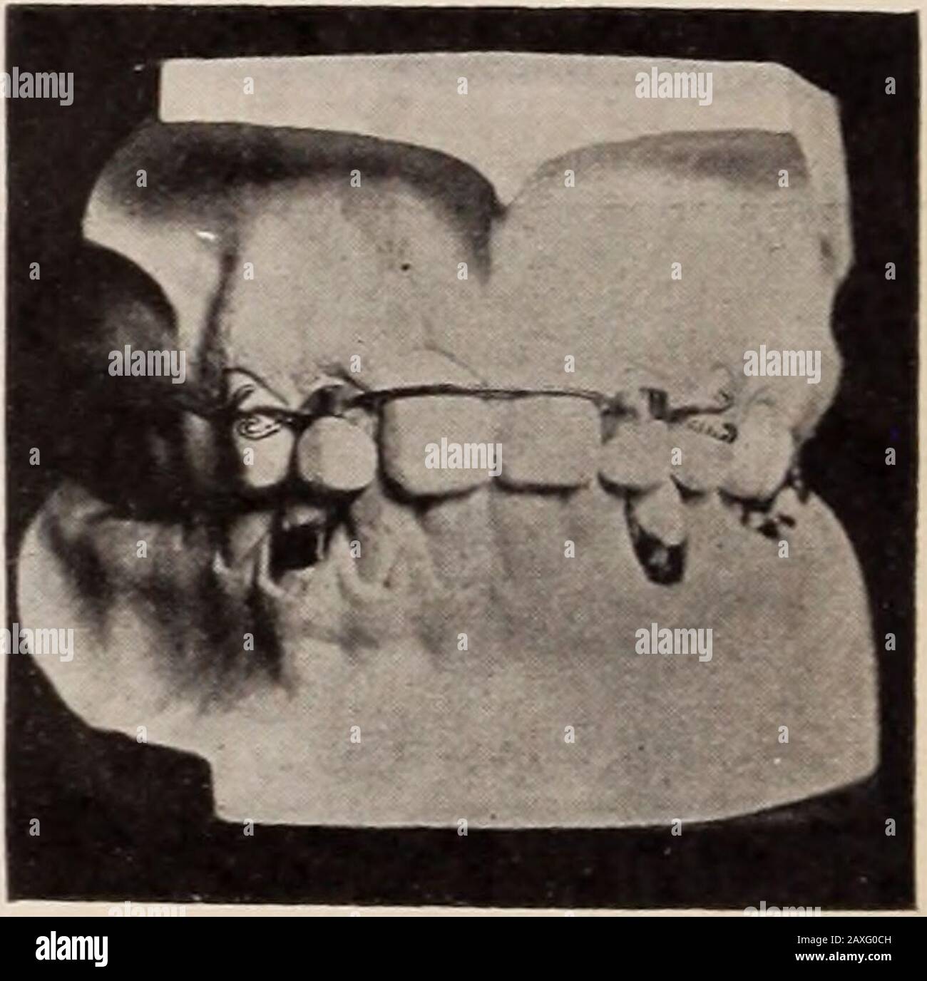 Dental review; devoted to the advancement of dentistry. . wire is soldered to the molarband, and this passes forward and the end, in the form of a hook,engages the staple on the cuspid band. A spur is soldered to themolar band which, when the teeth are together, occludes with the.spur on the upper molar band. Another small spur should be soldered 218 THE DENTAL REVIEW. on the distal side of the lingual surface of the molar band, it beingjust long enough to project onto the second molar. This will steadythe first molar and prevent it from expanding, which is sometimesliable to occur. The wire f Stock Photo