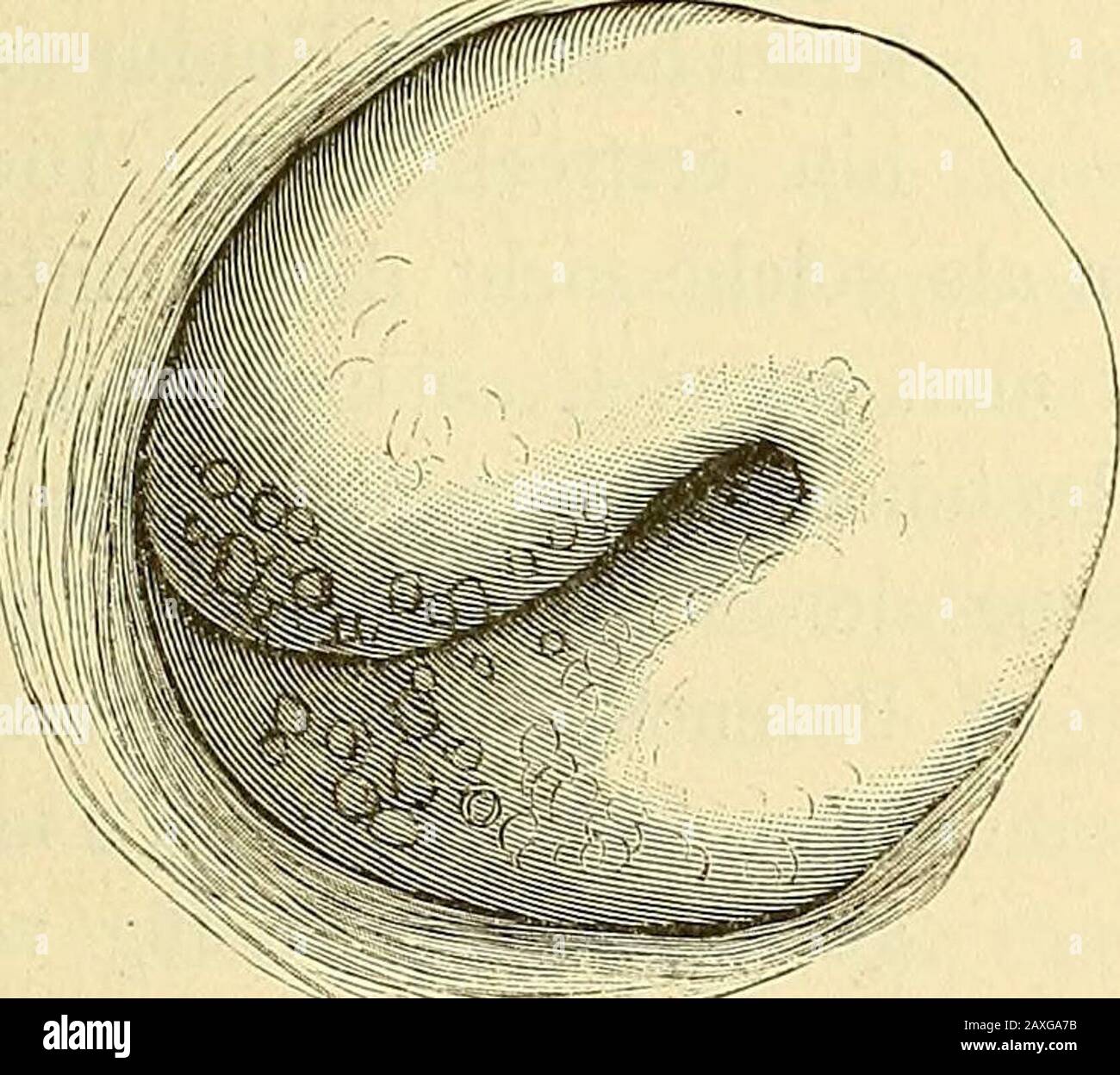 Pathologie und Therapie der Frauen-Krankheiten : nach den in den Feriencursen für Ärzte gehaltenen vorträgen . Bd. I, Heft 3 undKaanberg^ Kopenhagen 1884. — Schröder^ Americ. Journ. of Obstetr. Juli 1882. 3. Die Operation des Cervixrisses. 345 durch die Narbenverzieliuiig* in ihrer Umg-ebung zueiner unversiegbaren Quelle der Reizung und somit desFortbestehens solcher Erkrankungen werden. Nach diesen Beobach-tungen halte ich die Cervixrisse bei sonst gesunden Genitalverhält-nissen für unbedeutend und sehe in ihnen keine Indication, einzugreifen.Entwickeln sich Erkrankung-sprocesse in der Umgebu Stock Photo