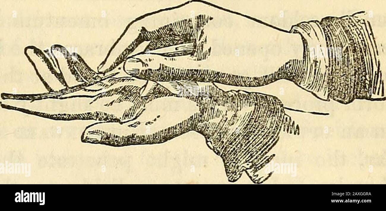 Lectures on the American eclectic system of surgery . blade is passed up flat-wise (see figure 139) along the finger andpushed on through the stricture. Its edge is then turned OPERATION FOR STRANGULATED HERNIA. 761 Fig. 139.. upward, cutting no more than necessary to admit the finger. The cut must, in all cases, be made directly Upward, parallel to the linea alba, whether it be in Direct or Oblique Inguinal Hernia, so as to avoid the epigastric artery. If there be no stricture in the neck of the sac, one may be found in the body. The stricture being thus relieved, and sufficiently dilated wit Stock Photo