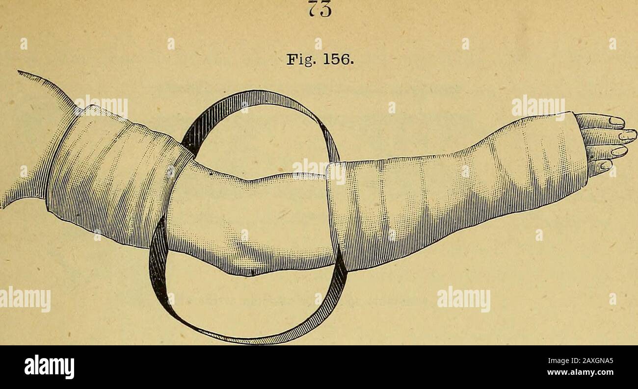 The surgeon's handbook on the treatment of wounded in war : a prize essay . Middle splint removed to renew the dressings. It is especially suitable for cases of extensive injuries to the softparts, and for the antiseptic treatment of wounds. C- The plaster of Paris bandage, interrupted with portions ofiron hoop (fig. 156), which are inserted between the layers of theplaster of Paris bandage, is especially useful for the practice of anti-septic dressing.. Interrupted plaster of Paris bandage with iron hoops. vj. So also is Volkmanns wire swing for the arm (fig. 157), inwhich the excised arm res Stock Photo