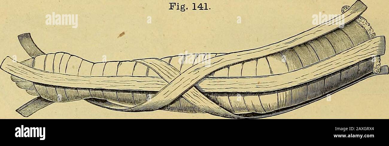 The surgeon's handbook on the treatment of wounded in war : a prize essay . STRO MEYERS obtuse-angled padded arm-splint. for the after-treatment of excision of the elbow in the Schleswig-Holstein war (1849 — 50). If the application of a starch bandage is desirable for chronicinflammation of the joint, the paste board trough (fig. 121), moistenedand smeared with starch paste, is very suitable for the reception ofthe limb. For more complicated injuries, and after excision of the joint, thereare used (3. The windowed plaster of Paris bandage at an obtuse angle(fig. 141 and 142) or Pie. 141.. Stri Stock Photo