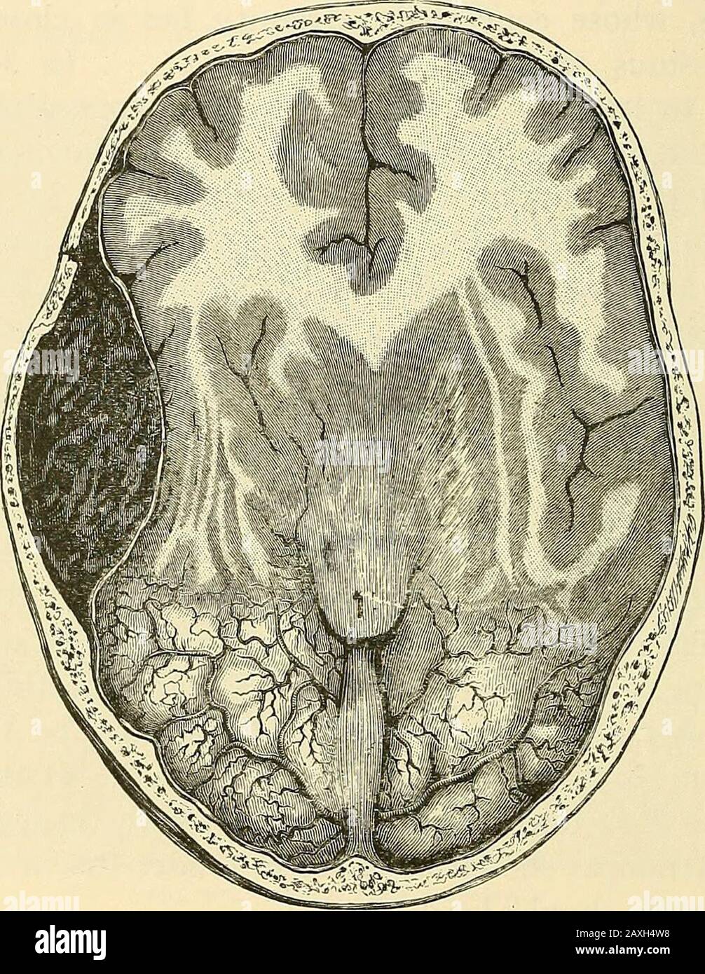 A manual of operative surgery . anyinjury to the dura itself this may be dealt with through the sameopening. Attempts should be made to render the cavity aseptic,and the wounds should be drained. The after-treatment is considered on page 44. 3. THE OPERATIVE TREATMENT OF INTRACRANIALHEMORRHAGE The whole subject of haemorrhage from the middle meningealartery has been thoroughly dealt with by Mr. Jacobson in a mostable article published in the Guys Hospital Reports for 1886.In the majority of cases the haemorrhage occurs from the middlemeningeal artery. Thus Prescott-Hewett (Holmess System 24 OP Stock Photo