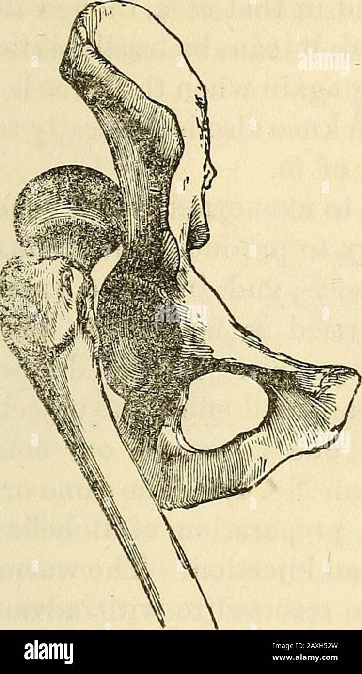 Lectures on the American eclectic system of surgery . ament, particularly the cotaloid ligament, which greatlydeepens the acetabulum, is subject to too much violence notto be occasionally dislocated. The thigh bone being insertedinto it obliquely, requires the more study to understand itsmechanism and derangements. Four distinct dislocations require to be noticed. The headof the femur may be thrown, 1st, upioard, on the Dorsum ofthe Ilium (Fig. 49); 2d, downward into the Foramen Ovale,(Fig. 50); 3d, backward into the Ischiatic Notch (Fig. 51); 4th,forward and upward onto the pubes, (Fig. 52.) Stock Photo