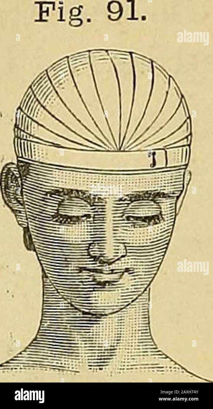 The surgeon's handbook on the treatment of wounded in war : a prize essay . 50 e. The capelline (mitra Hrppokratis)(fig. 91) is a double-headed bandage,one end of which passes round thehead from forehead to occiput, and fixesthe turns of the other end, which iscarried alternately over the right andleft parietal bone: each turn over-lapping the preceding one. The capelline bandage. B. HANDKERCHIEF BANDAGES. a. The triangular handkerchief for the head (Kopftuch) (capitiumparvum triangulare) (fig. 92 and 93). The centre of the triangular hand- Fig. 92. Fig. 93. Stock Photo