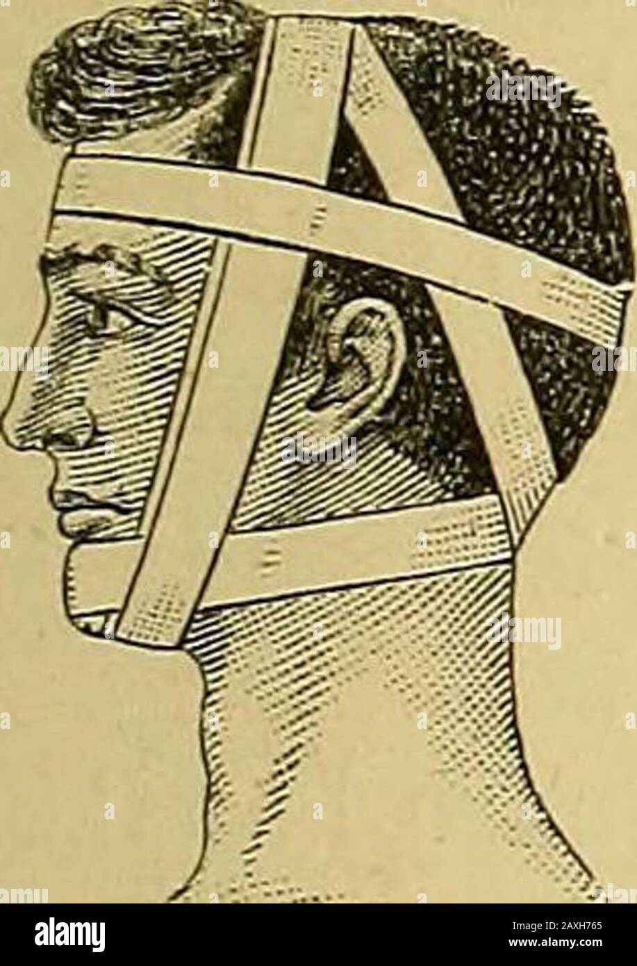 The surgeon's handbook on the treatment of wounded in war : a prize essay . Double-headed roller. Sagittal bandage. Knotted bandage. Fig. 90. c. The knotted bandage (fascia nodosa) (fig. 89) is a double-headedroller, whose turns are crossed at right angles upon the wound, andtightly drawn, as in tying up a parcel (Paekknoten). It is especiallysuitable for haemorrhage, where considerable pressure is required. Forthe same purpose, a tightly stretched cravat or a piece of india-rubberbandage may be used. d. The halter bandage (capistrum) (fig. 90).The first turn begins on the top of the head,cros Stock Photo