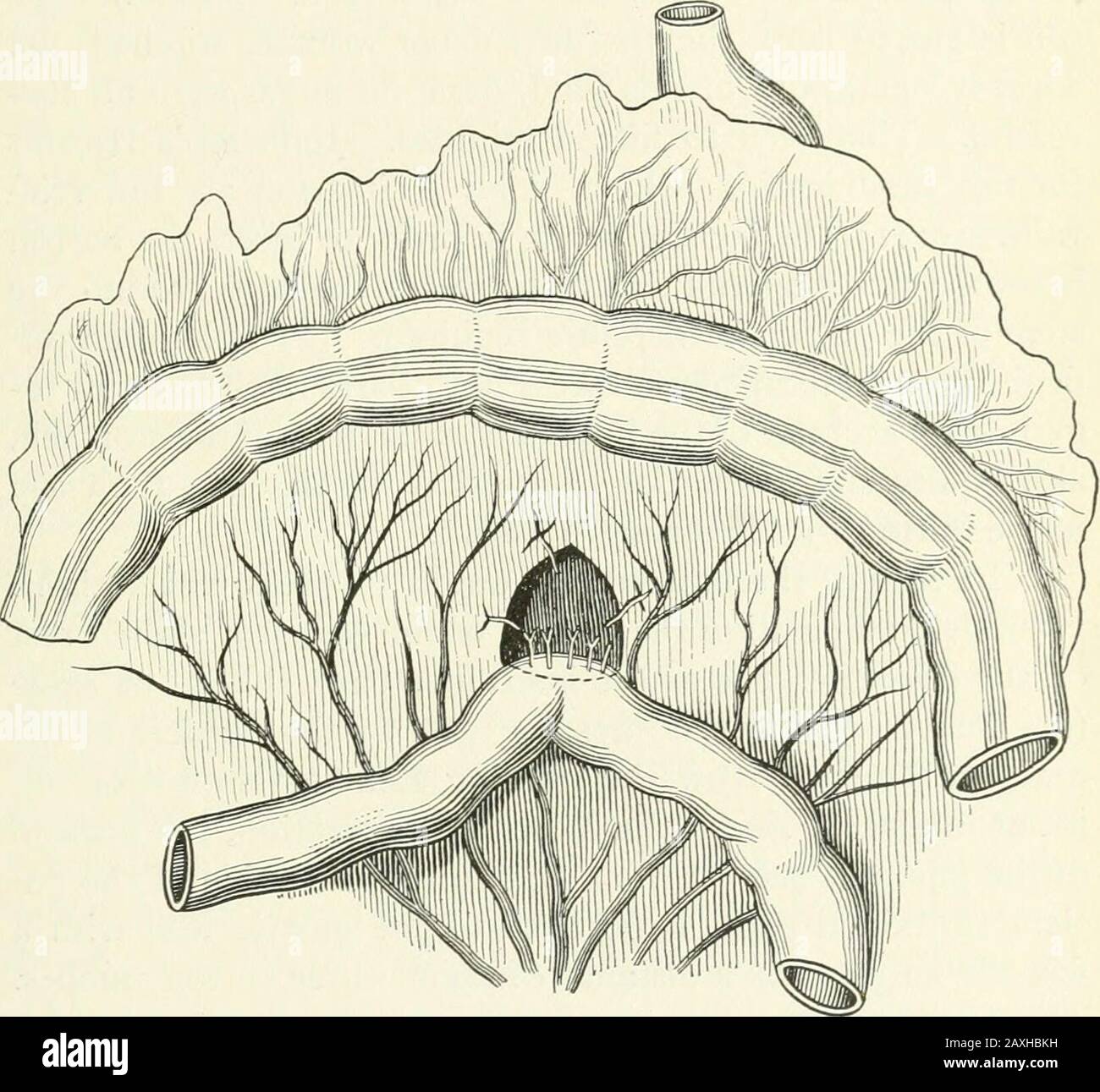 Annals of surgery . Fig. 3.—Plica duodeno-jejunalis ; transverse colon ...