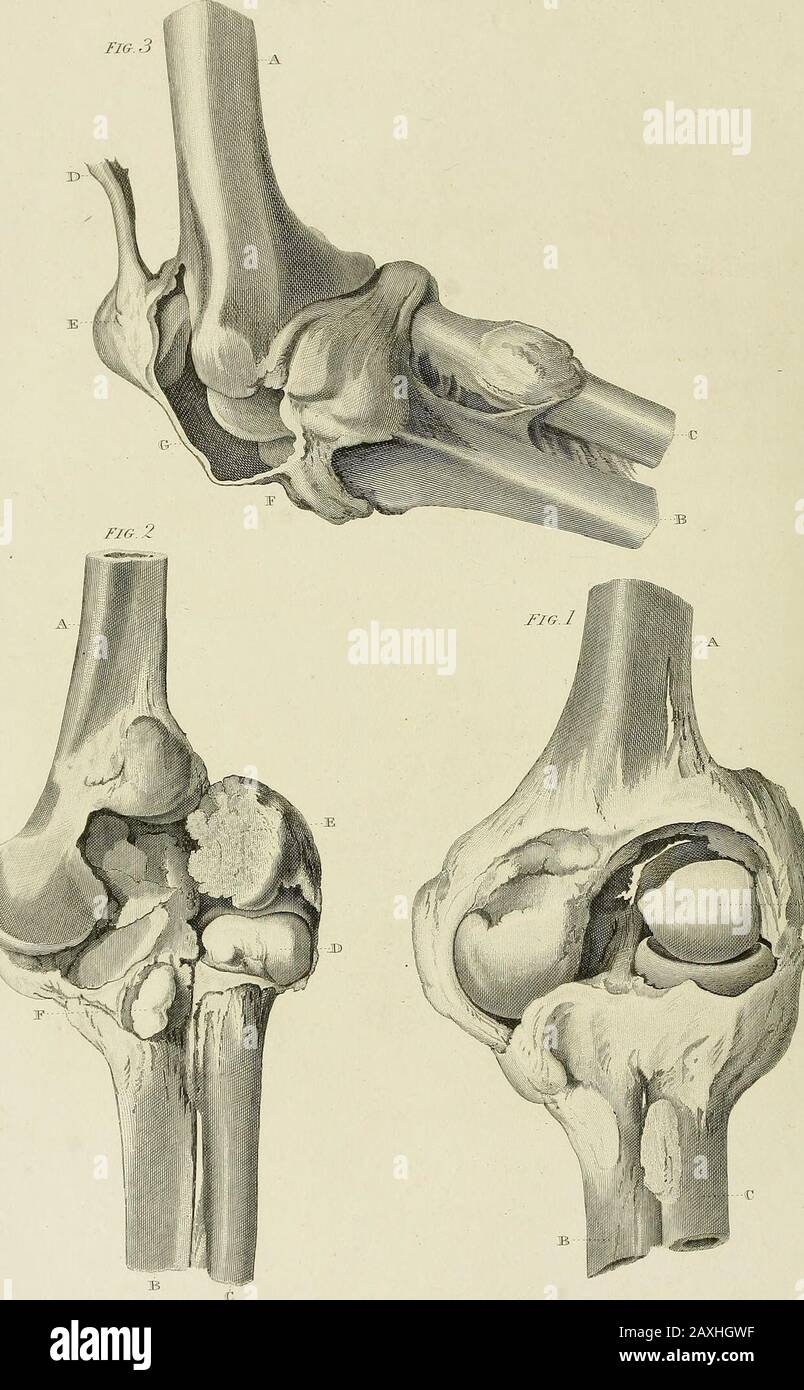 A treatise on dislocations and on fractures of the joints . FVibKshcd bvibdcT Cooper.i3s: iLTiflnnai /V CJ-Cnnten. PLATE XXVI. Shews a dislocation of the radius backwards, behind, andto the outer side of the external condyle of the os hun i. A. Os humeri B. Radius C. Ulna D. Internal condyle of the os humeri E. Coronoid process of the ulna; the capsular lig-ament being- opened to shew D. and E. F. The head of the radius dislocated backwards and outwards G. The coronary ligament torn through. Given by Mr. Poingdestre. Drawn by Mr. Sylvester. MuseuMi St. Thomass Hospital. PL.XXMl, FI& 3. Iiitli; Stock Photo