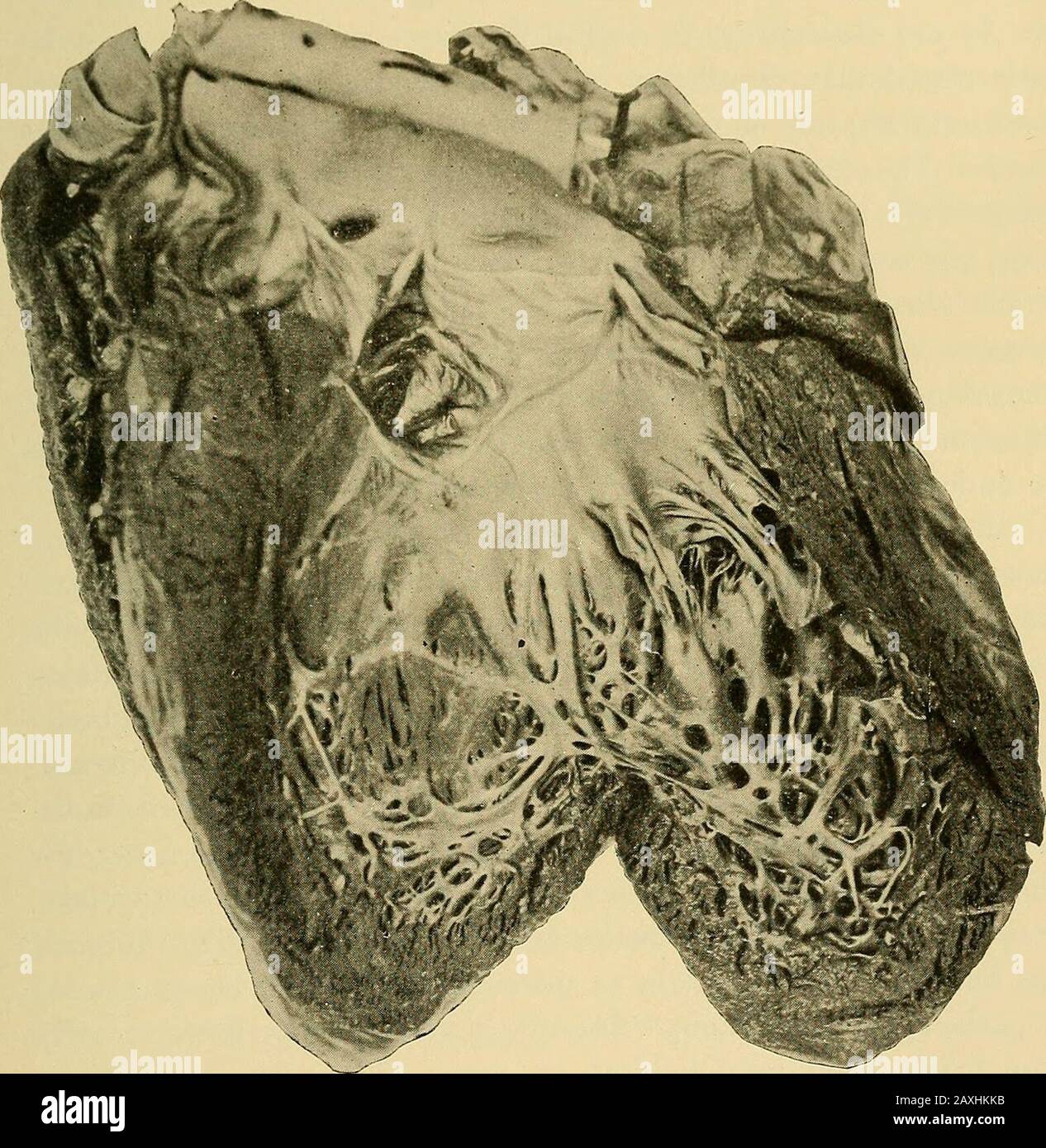 Diseases of the heart and arterial system : designed to be a practical presentation of the subject for the use of students and practitioners of medicine . s. Stenosis of the pulmonary or aortic orifices may result fromthe more or less complete fusion of all three cusps (Fig. 78), andthis may even proceed to complete atresia. The fusion may bethe result of foetal endocarditis or developmental error. In theformer case the valve presents much the same appearance as after686 COXliKNITAIi IMSKASKS OF TIIK HEART 687 postnatal endocarditis. Vegetations may cover the cusps, projectinto the ventricle, Stock Photo