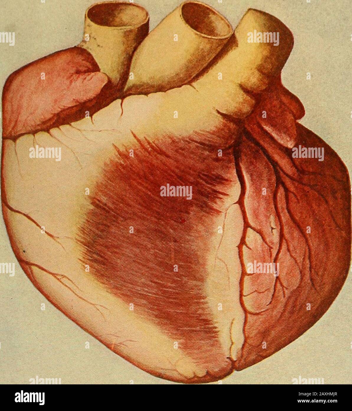 Diseases of the heart and arterial system : designed to be a practical presentation of the subject for the use of students and practitioners of medicine . ly or acutely induced, and independent of previous recognis-able myocardial or endocardial disease. Morbid. Anatomy.—By dilatation of the heart is meant anincrease in the capacity of its chambers due to rapid or gradualstretching of its walls. In most cases hypertrophy is combinedwith dilatation and has preceded the development of the latter.A dilated heart is as large or larger than one only hypertrophied,but the muscle is flabby, and the o Stock Photo