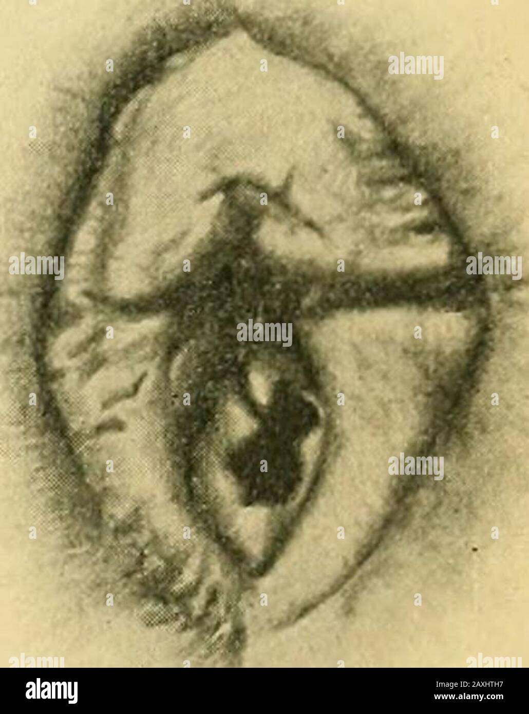 hymen child 