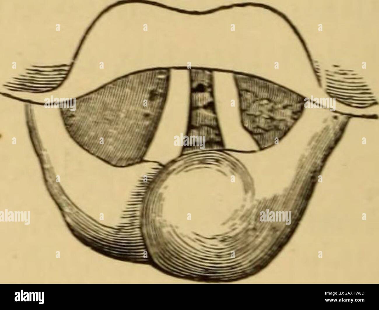 Diseases of the throat and nasal passages; a guide to the diagnosis and treatment of affections of the pharynx, sophagus, trachea, larynx, and nares . Fig. 1Q5.—Paralysis of left vocal cord in acase of phthisis. Appearance during respira-tion. Fig. 1%.—Paralysis of left vocal cord ina case of phthisis. Appearance during attemptat phonarion. 1961 but there is no approximation of the cords even thoughthe crossing takes place. The diagnosis of unilateral paralysis being made by laryn-goscopy inspection, it becomes necessary to make a thoroughexamination of the neck and chest, and interrogate othe Stock Photo