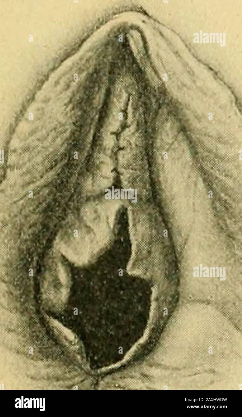 The practice of obstetrics, designed for the use of students and  practitioners of medicine . Fig. 9.—Circular HymenWITH Wide Opening  andCircular Smooth-edgedMargin of EquableHeight Throughout, Fig.  10.—SemilunarHymen. Fig. II.—SemilunarHymen.. ,. if ...