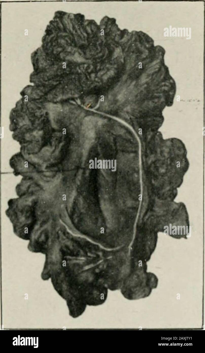 On retro-peritoneal hernia . VI. A—RIGHT DUODENAL HERNIA. Tlie line ofsuperior mesen-teric artery.. VI. B.—RIGHT DUODENAL HERNIA THE S.VC IS EMPTY TI i62 DESCRIPTION OF PLATE VII. VIL—SPECIMEN 1281. ST. THOMASS HOSPITAL. A caecum, etc., with the terminal portion of the ileum.Behind the ascending colon are two capacious pouches of peri-toneum, situate one immediately above the other, and freelycommunicating with the general peritoneal cavity on the rightside. The vermiform appendix lies in the lower of the sacs. This is the most perfect example of two retro-colic fossa?,external and internal, t Stock Photo