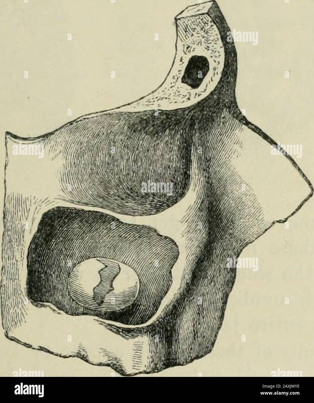 Injuries and diseases of the jaws . reserious operation ; but a case has occurred within my ownknowledge in which a very able surgeon removed the upperjaw before discovering the error of his diagnosis. M. Giraldes would appear to have been the first authorupon the subject of cysts of the antrum, and his thesisgained the Montyon prize in 1853: but Mr. W. Adams mayfairly claim priority of investigation, as shown by specimenspreserved in St. Thomass Museum—as indeed is acknow-ledged by M. Giraldes. Luschka subsequently investigatedthe subject, and in sixty post-mortem examinations foundcystic gro Stock Photo