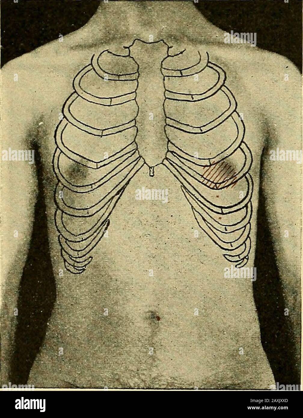 Diseases of the heart and arterial system : designed to be a practical presentation of the subject for the use of students and practitioners of medicine . s term is too restricted, however; since, as is well known,the bruit in some cases commences before the contraction of the auricle, in fact immediatelyafter the second sound, andlasts throughout the longpause. It is consequently adiastolic and not always anauricular systolic murmur,and as such is in contrast tothe systolic one of mitral re-gurgitation. It has also beencalled the mitral directmurmur, because transmittedin the direction of the Stock Photo