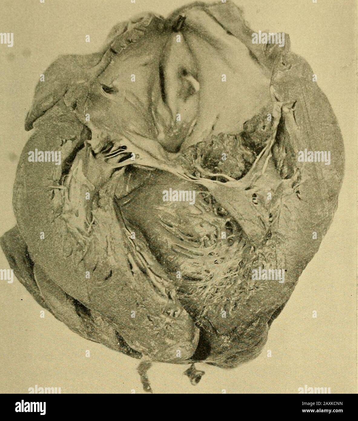 Diseases of the heart and arterial system : designed to be a practical presentation of the subject for the use of students and practitioners of medicine . if the eroded surface is notat once covered by the deposit of fibrin from the blood, a consid-erable loss of substance may take place. This is far more common,however, in the malignant form, although it has been observed insimple endocarditis complicating rheumatism. More commonlythe eroded surface, necrotic from the action of bacteria, is at oncecovered by a deposit of fibrin from the blood. This fibrin forms afirm warty mass of a yellowish Stock Photo