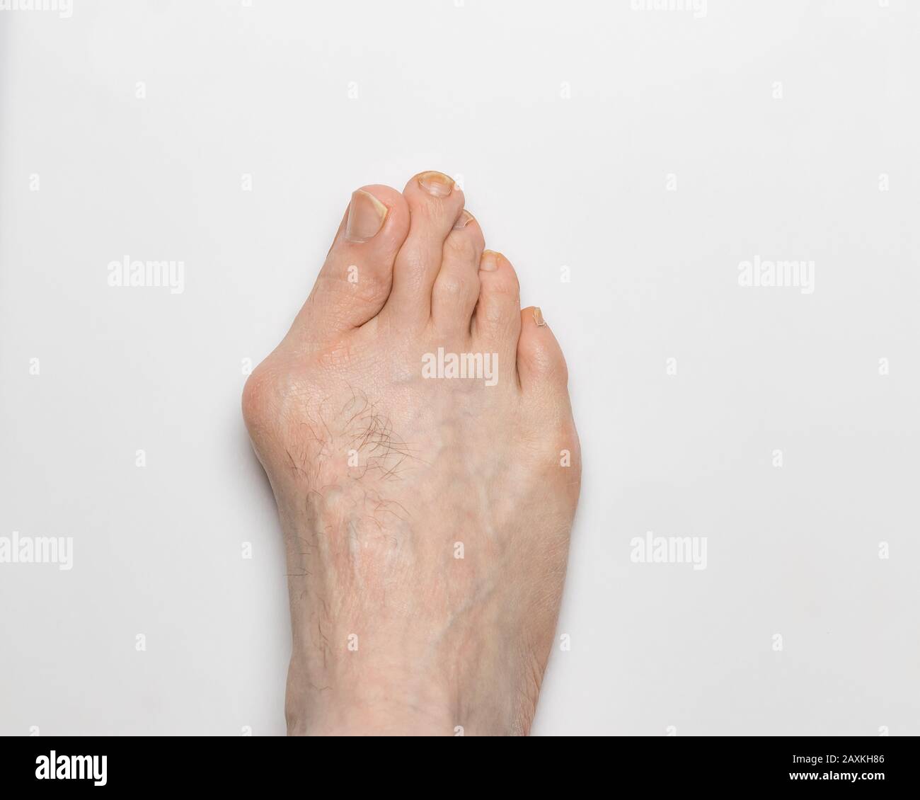 Closeup of left, right foot with bunion, hallux valgus, on big toe causing deformity Stock Photo