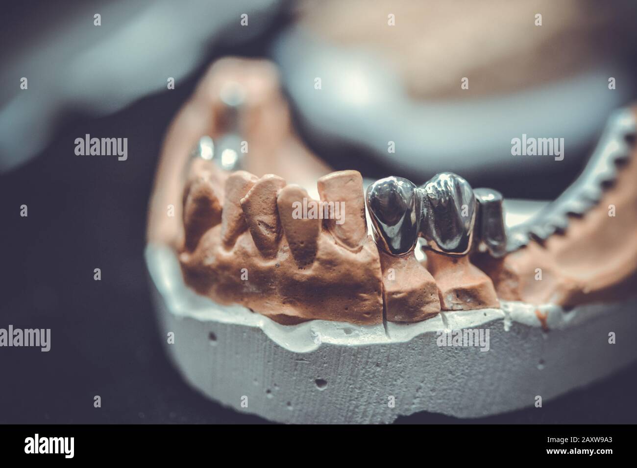 example of a bridge on an artificial human jaw close-up Stock Photo