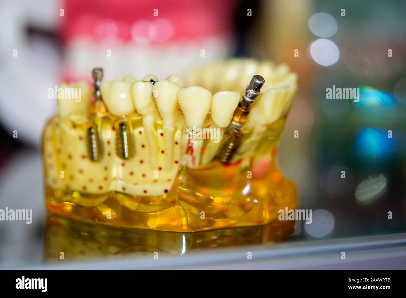 Transparent Model of Human Teeth with implants closeup Stock Photo Alamy