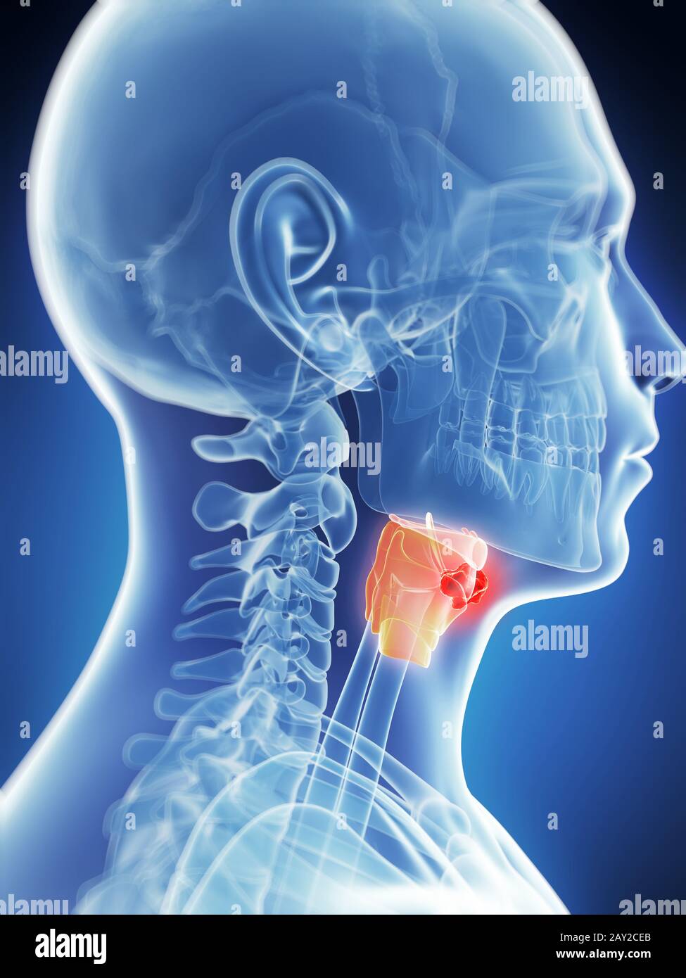 Larynx cancer hires stock photography and images Alamy