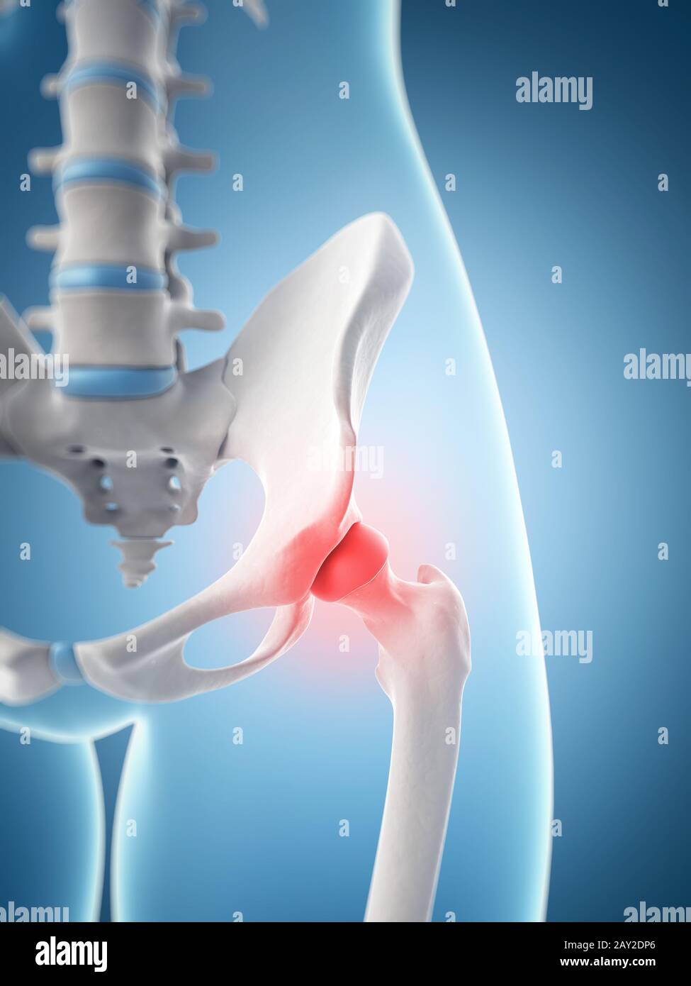 inflamed hip joint Stock Photo