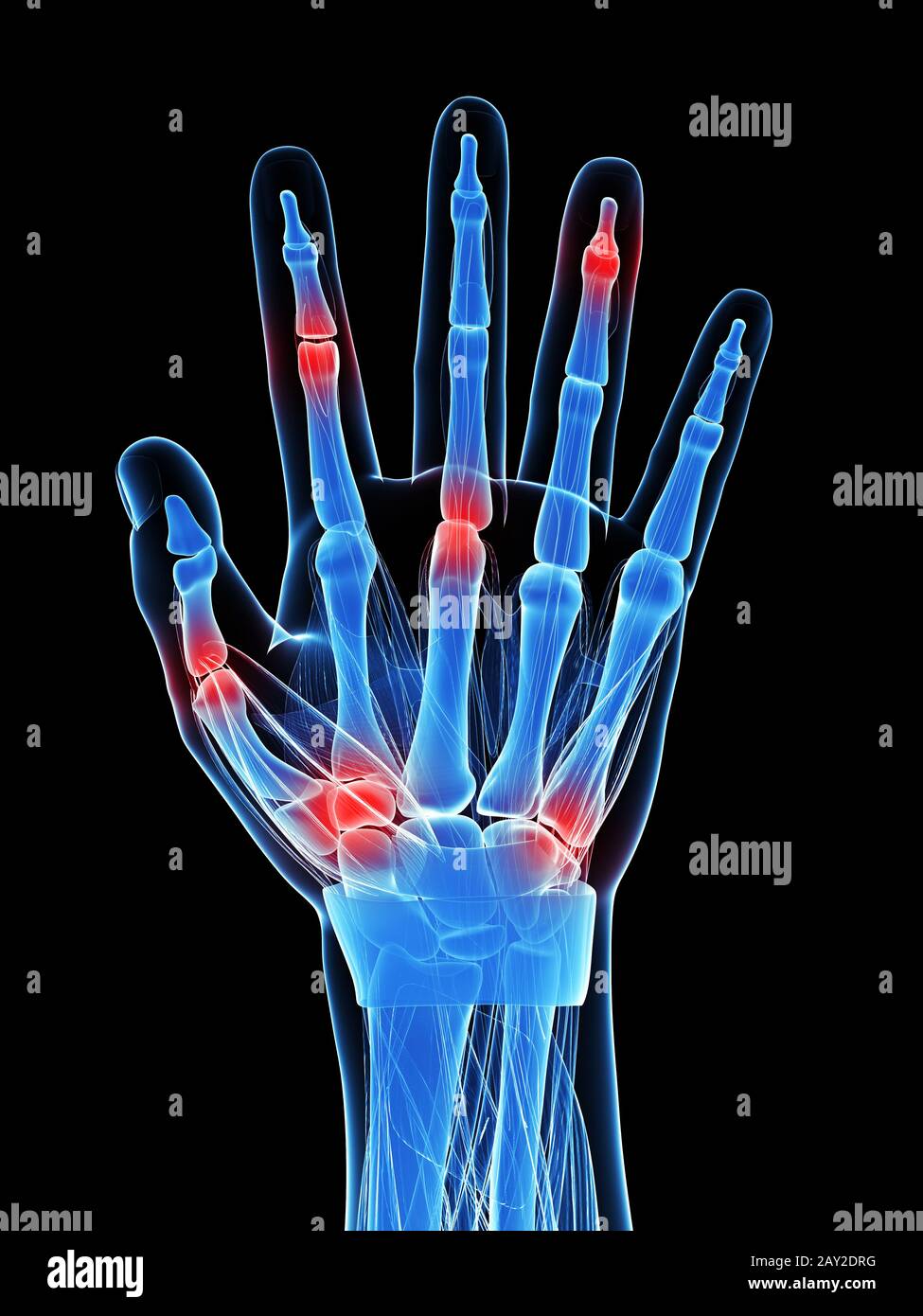 Painful finger joints hires stock photography and images Alamy