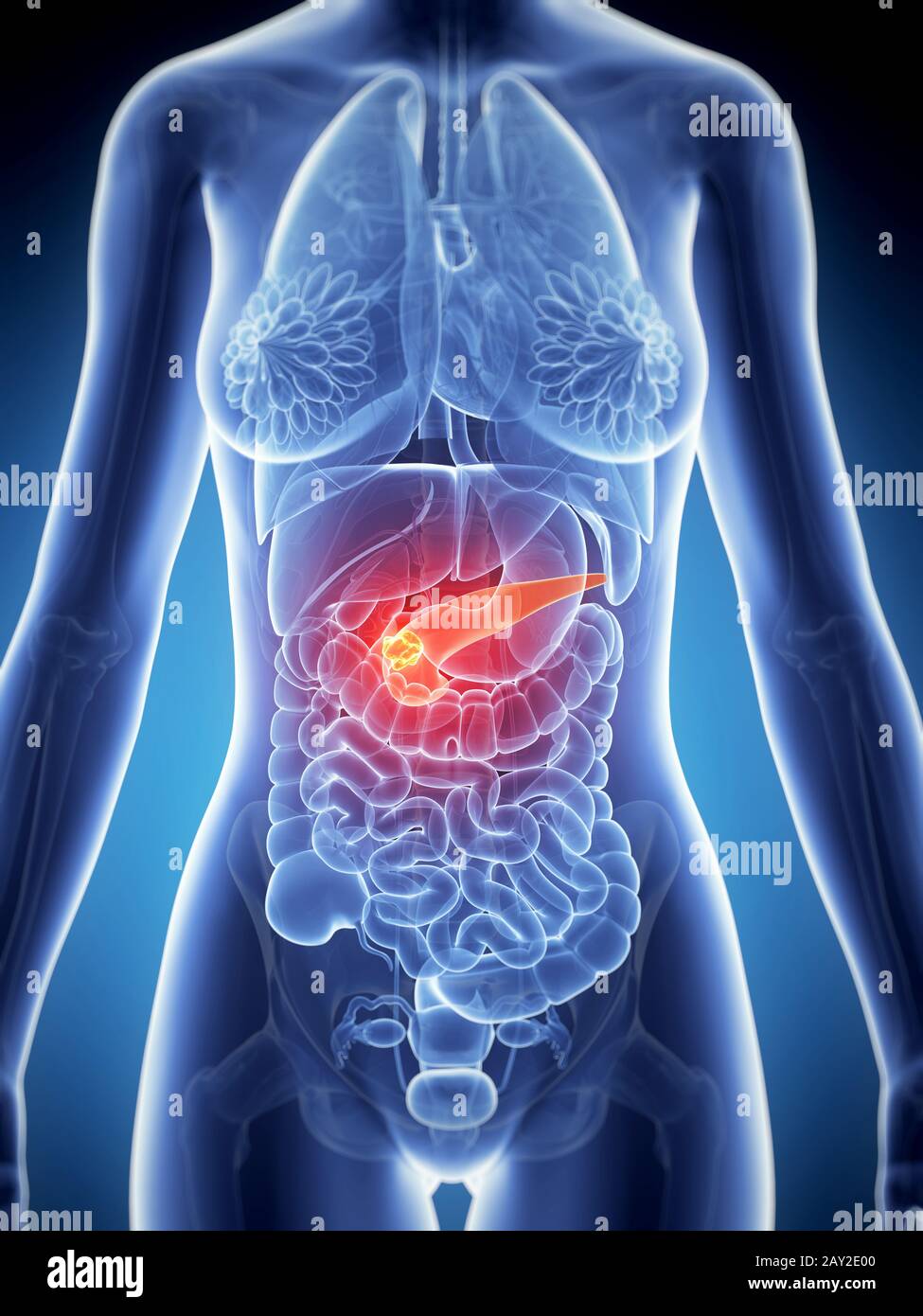 3d rendered illustration of the female anatomy - pancreas cancer Stock ...