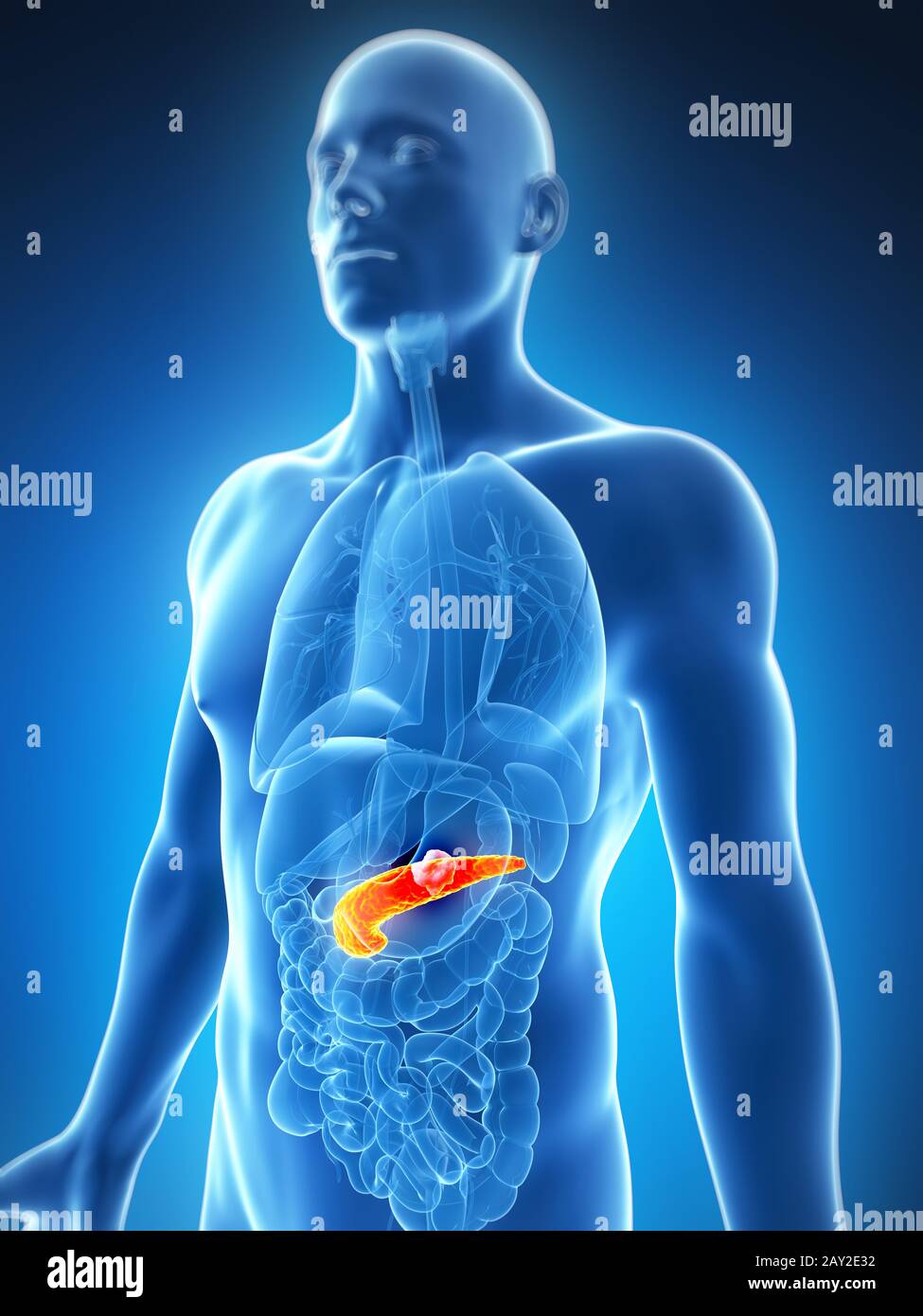 Pancreas cancer hi-res stock photography and images - Alamy