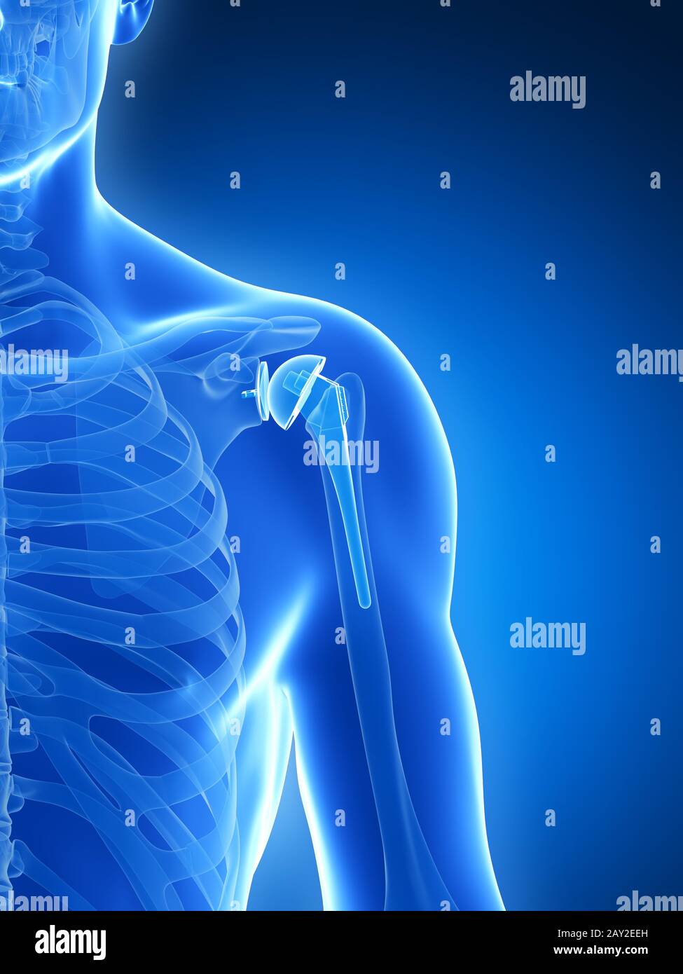 3d rendered illustration of a shoulder replacement Stock Photo Alamy