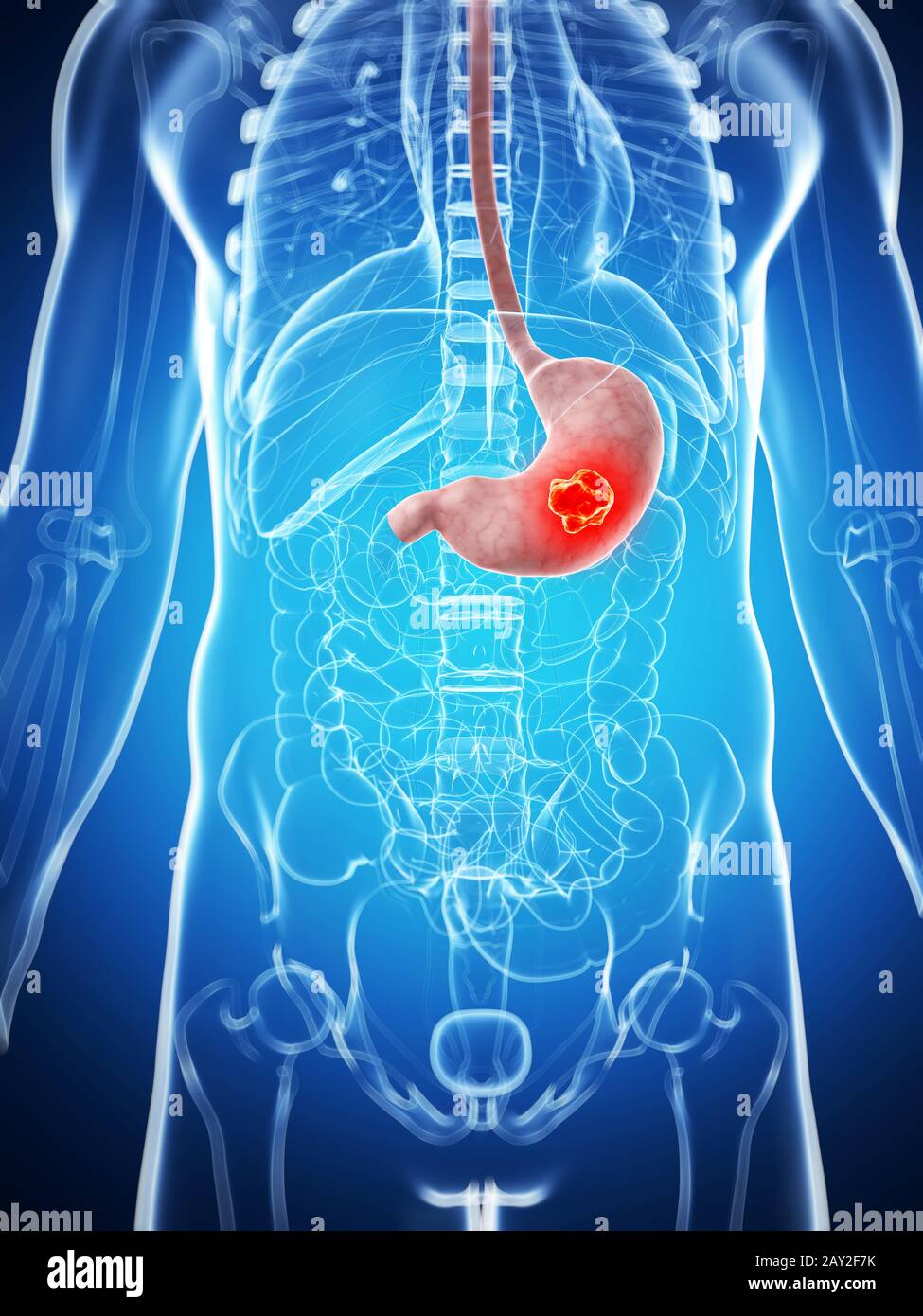 Abscess stomach hi-res stock photography and images - Alamy