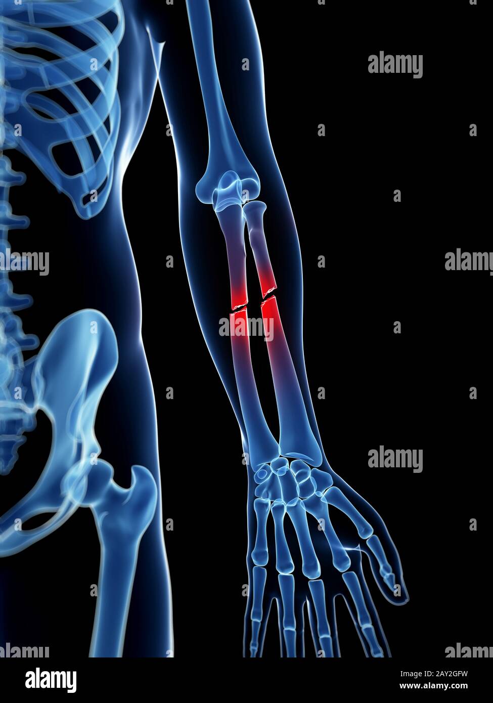 medical illustration of a broken lower arm Stock Photo