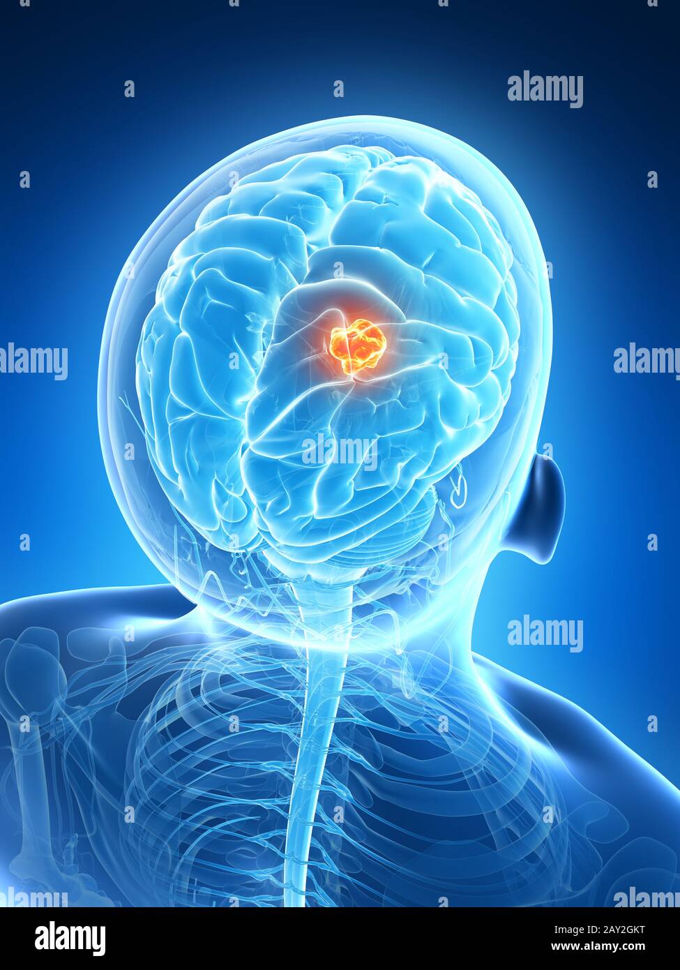 3d rendered illustration - brain tumor Stock Photo - Alamy
