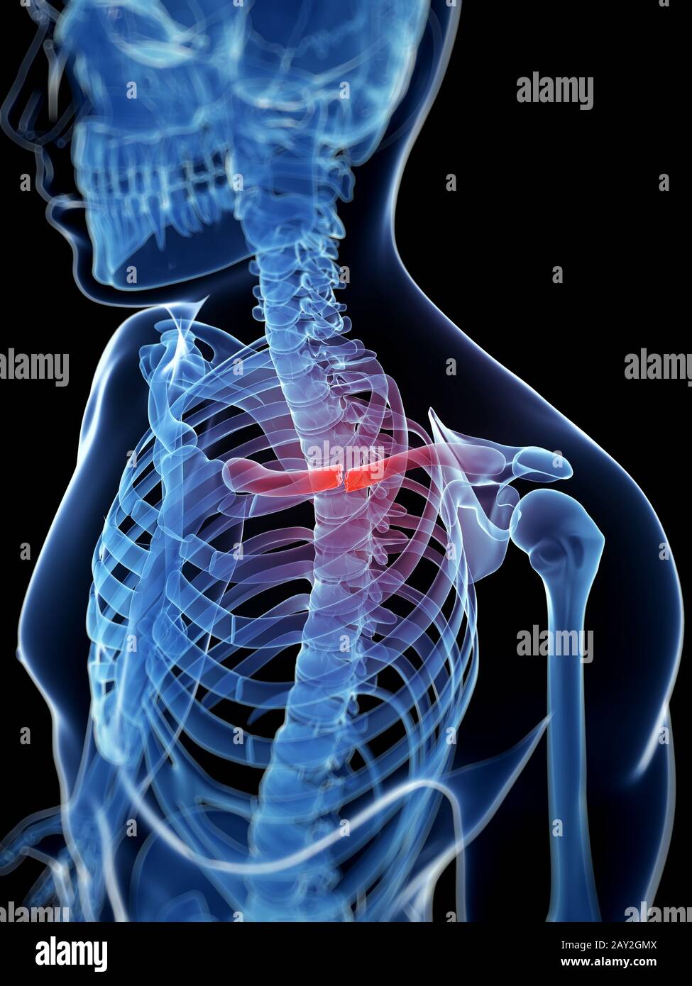 medical illustration of a broken clavicle Stock Photo