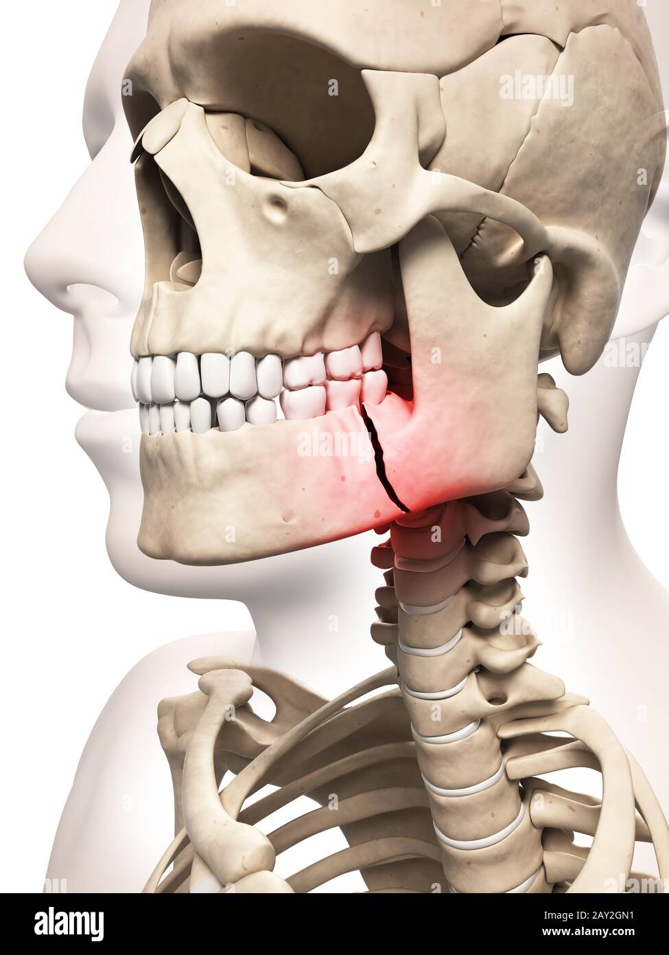 medical illustration of a broken jaw bone Stock Photo