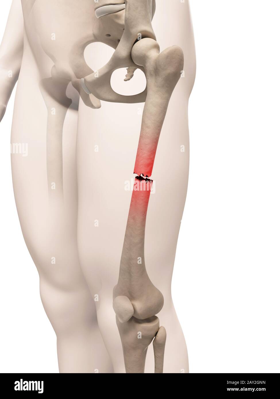medical illustration of a broken leg bone Stock Photo
