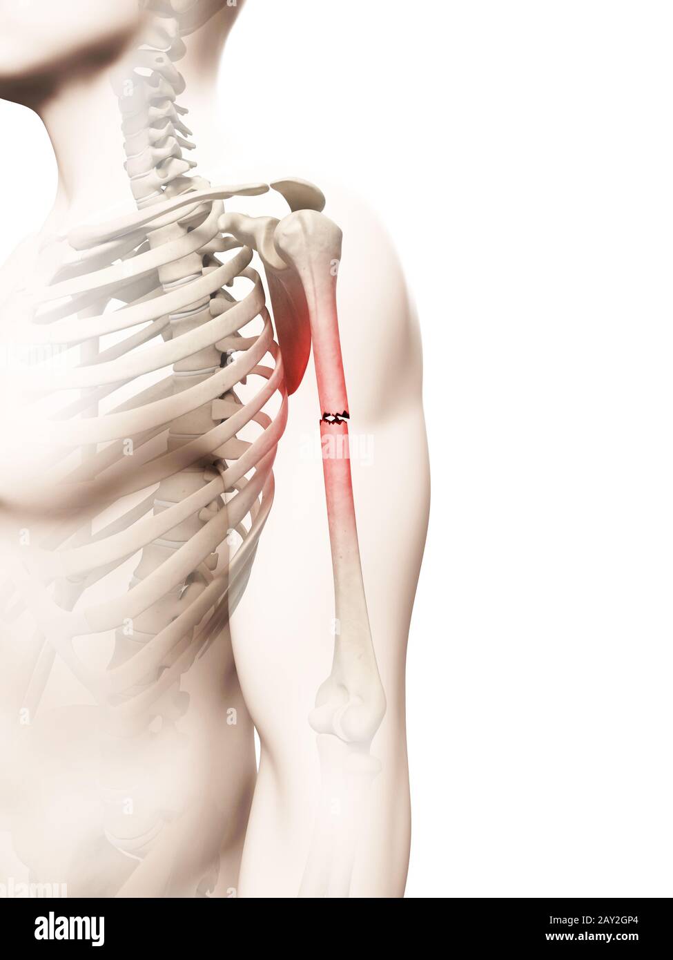 medical illustration of a borken arm bone Stock Photo