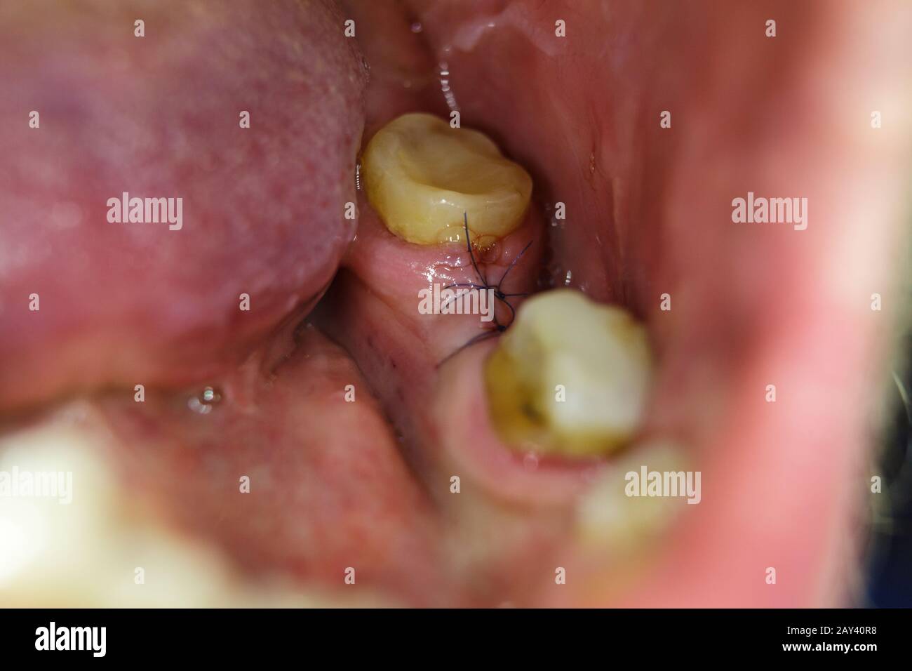 Jaw After Tooth Extraction Sutured Tissue Stock Photo Alamy