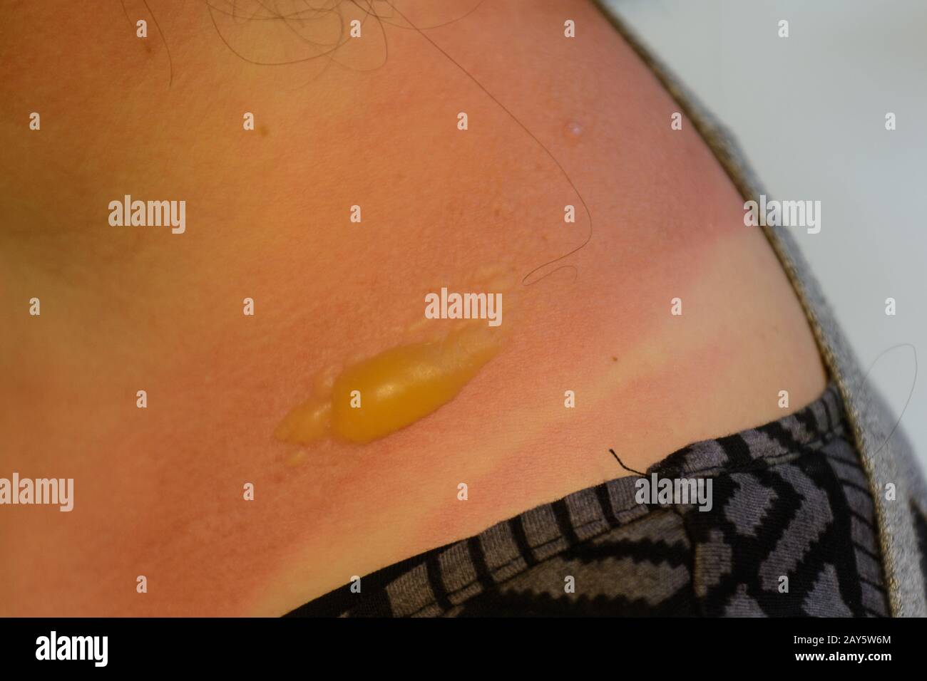 Sunburn with large blister on the shoulder Stock Photo