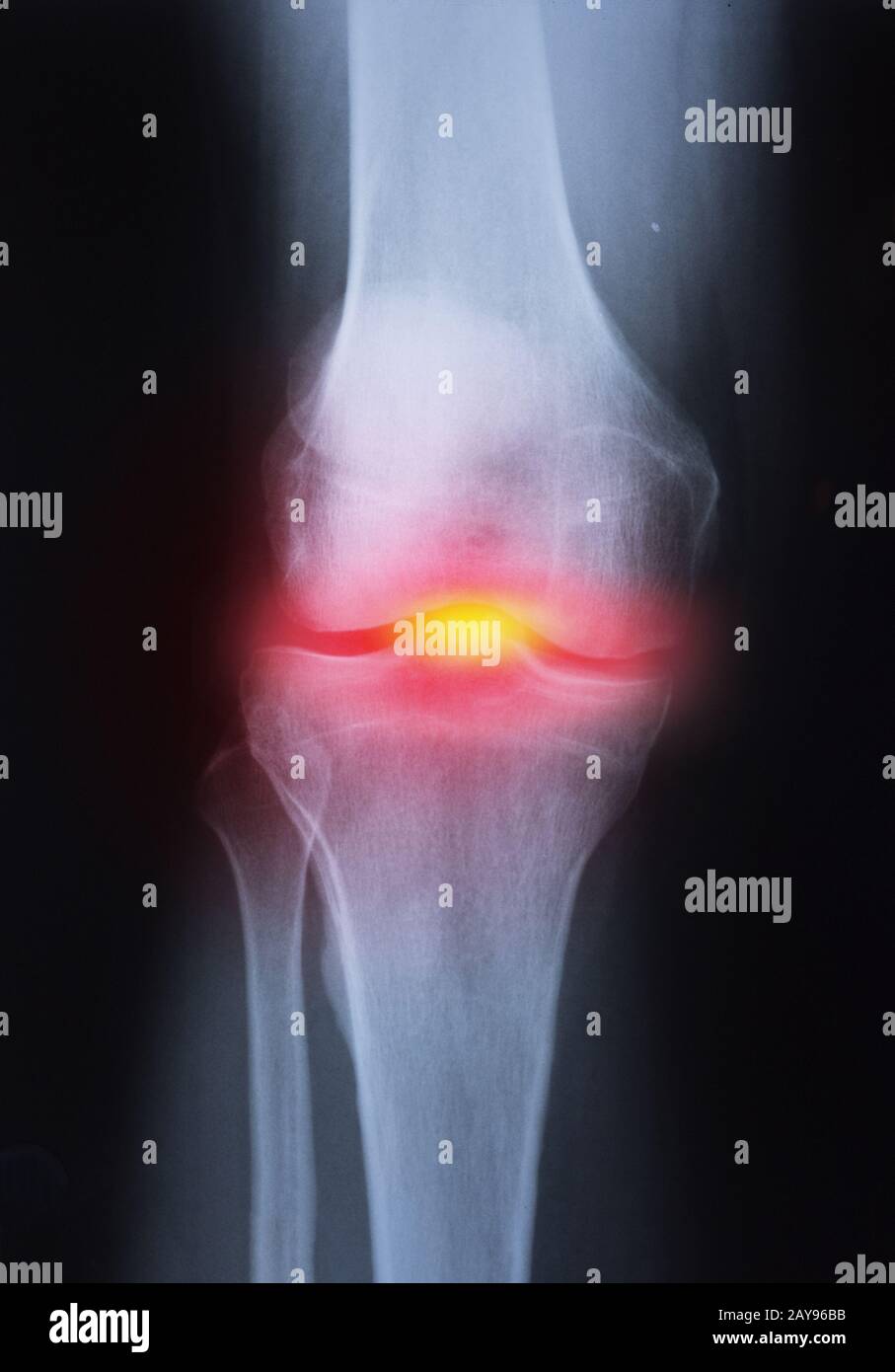 Medical xray knee joint image with arthritis ( Gout , Rheumatoid