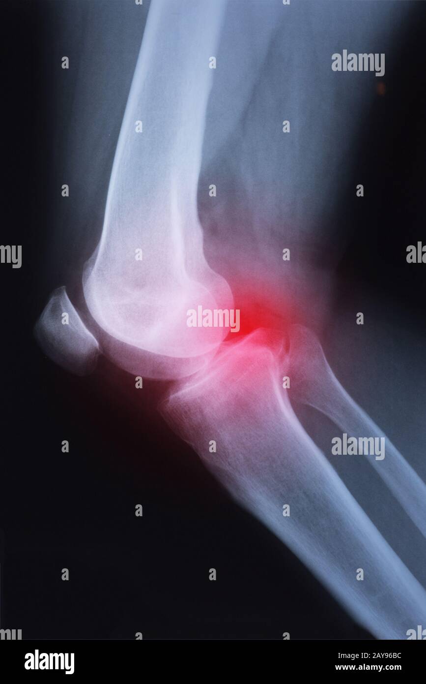 Medical xray knee joint image with arthritis ( Gout , Rheumatoid arthritis , Septic arthritis