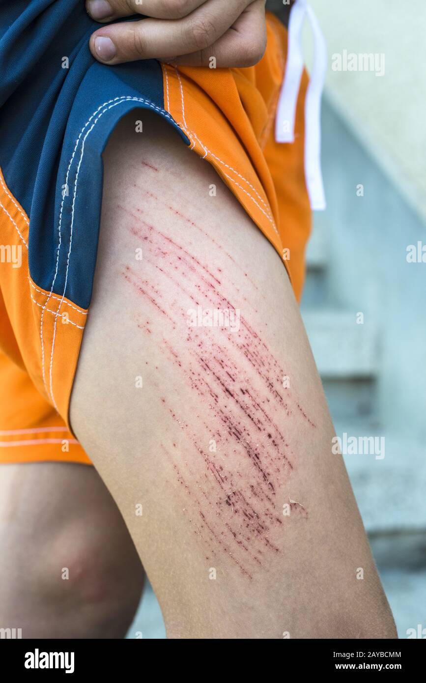 Bruise wound child Stock Photo Alamy