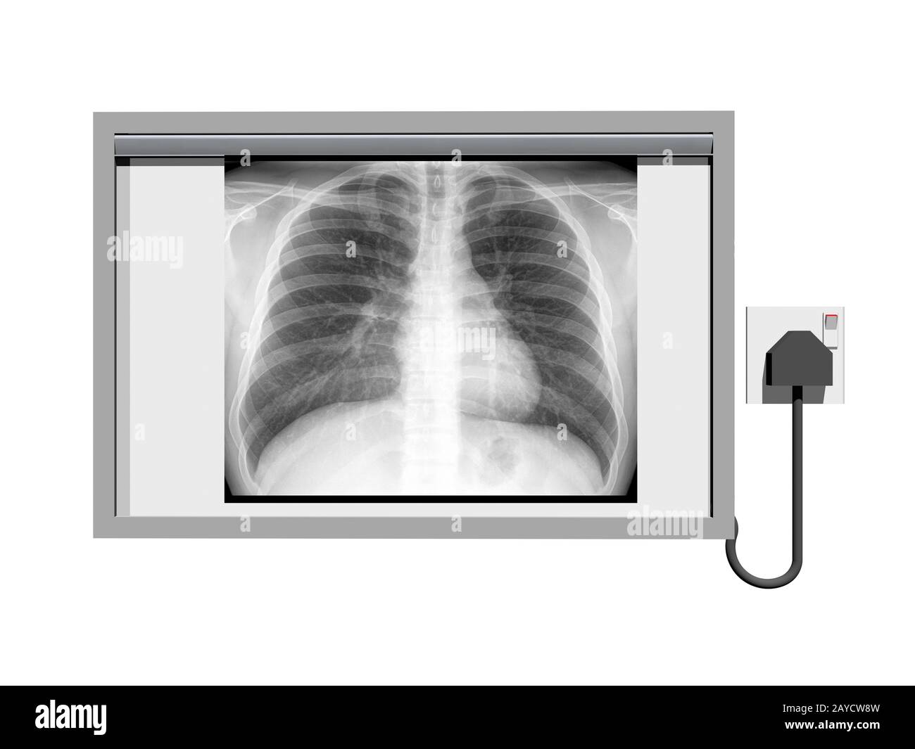 X-ray viewer with Brustkoprb in x-ray Stock Photo